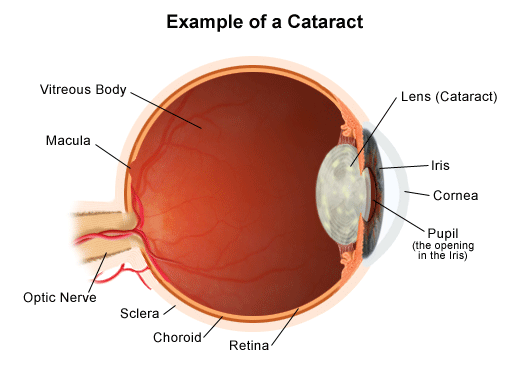 reasons to undergo cataract removal surgery